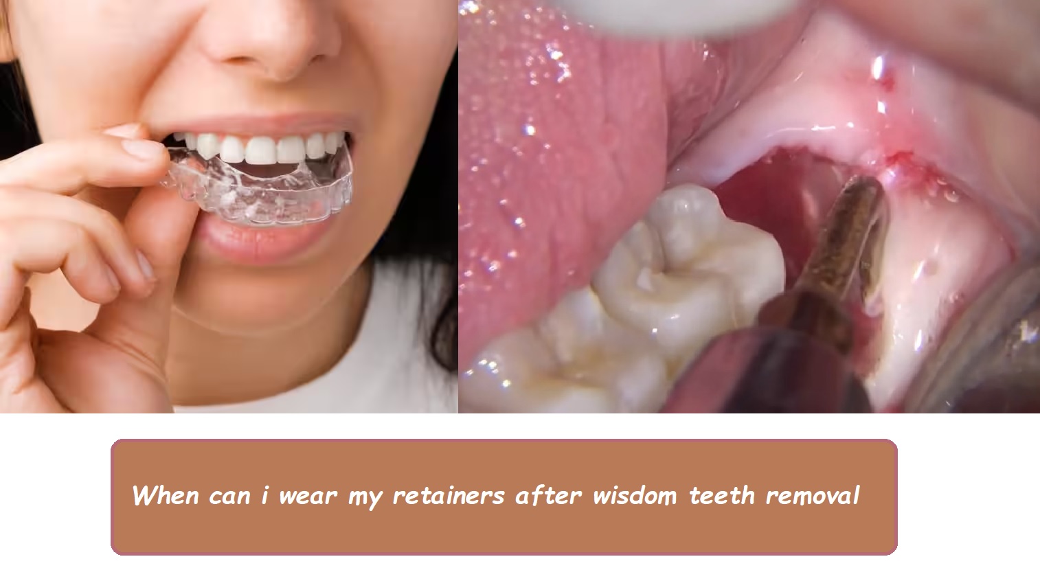 When can i wear my retainers after wisdom teeth removal