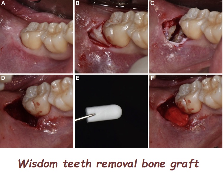 Wisdom teeth removal bone graft