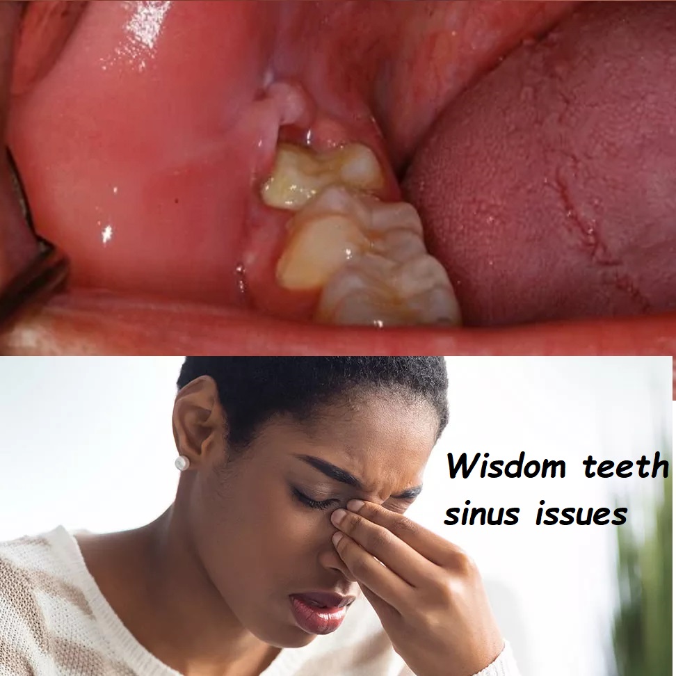 Wisdom teeth sinus issues