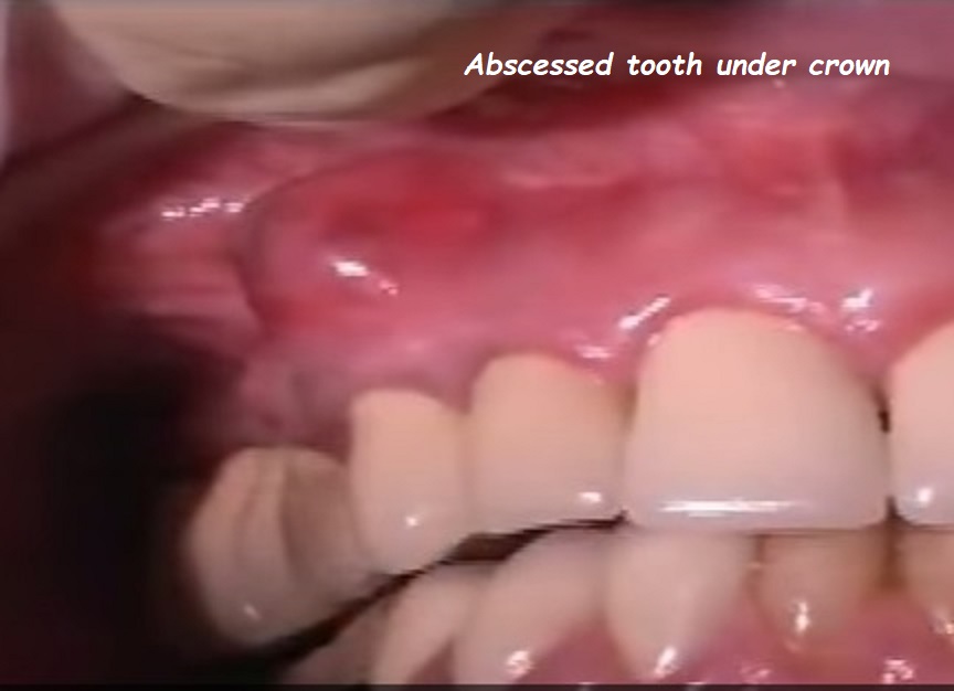 abscessed tooth under crown