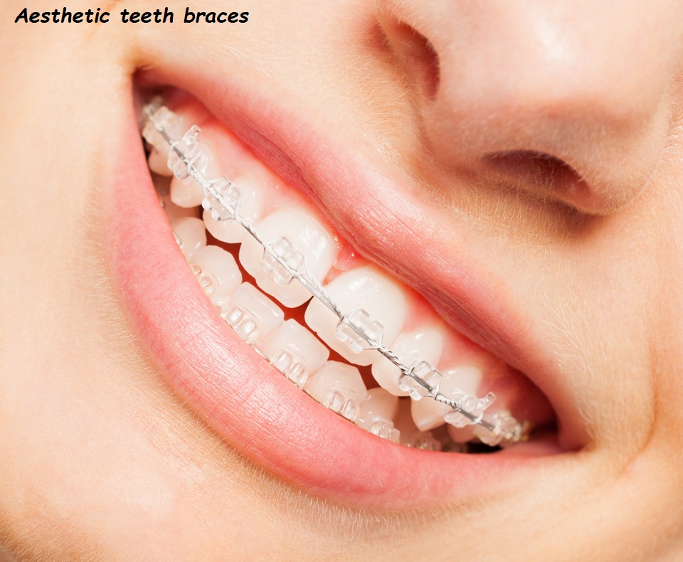 aesthetic teeth braces