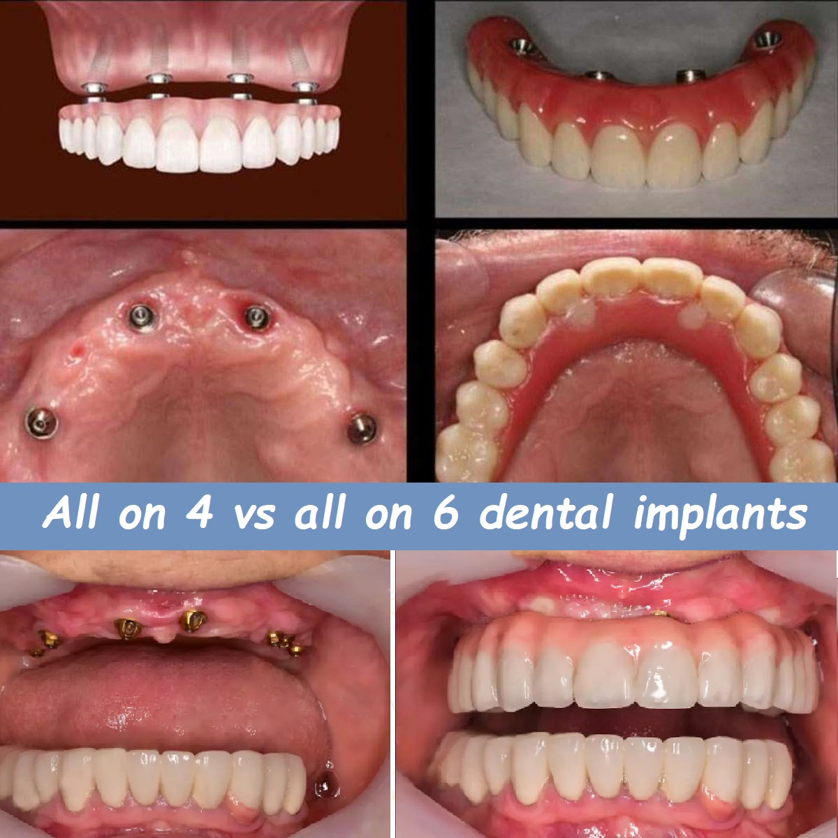 All on 4 vs all on 6 dental implants