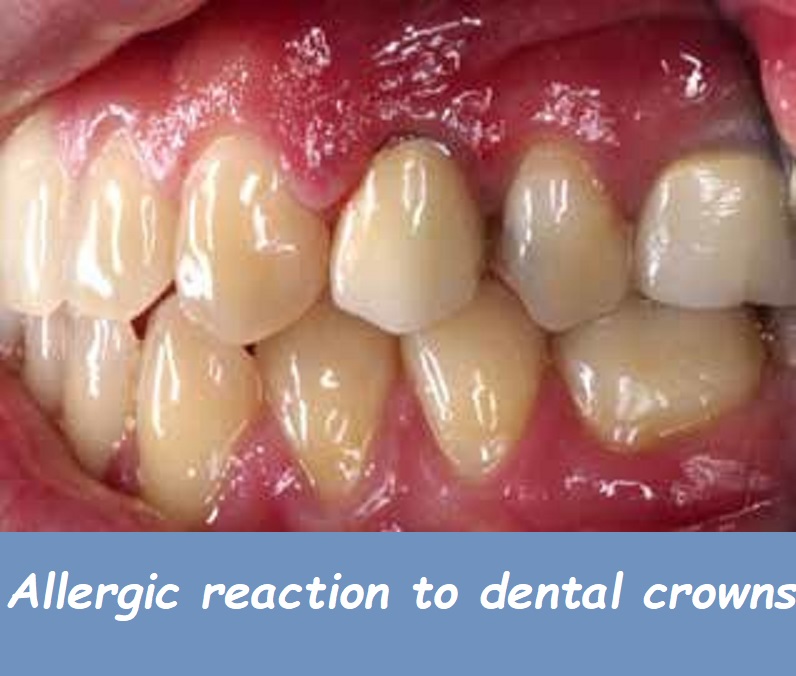 allergic reaction to dental crowns