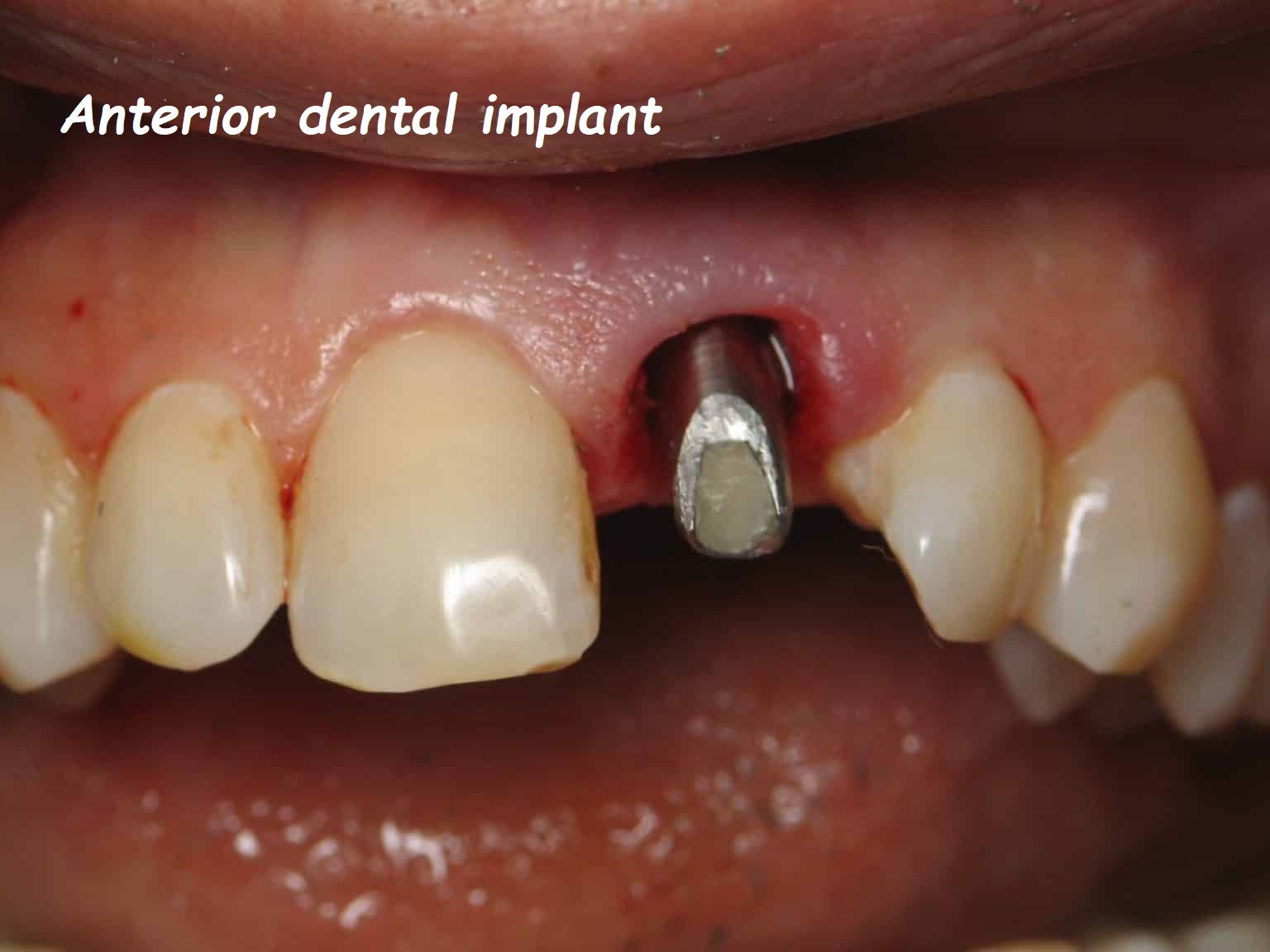 Anterior dental implant