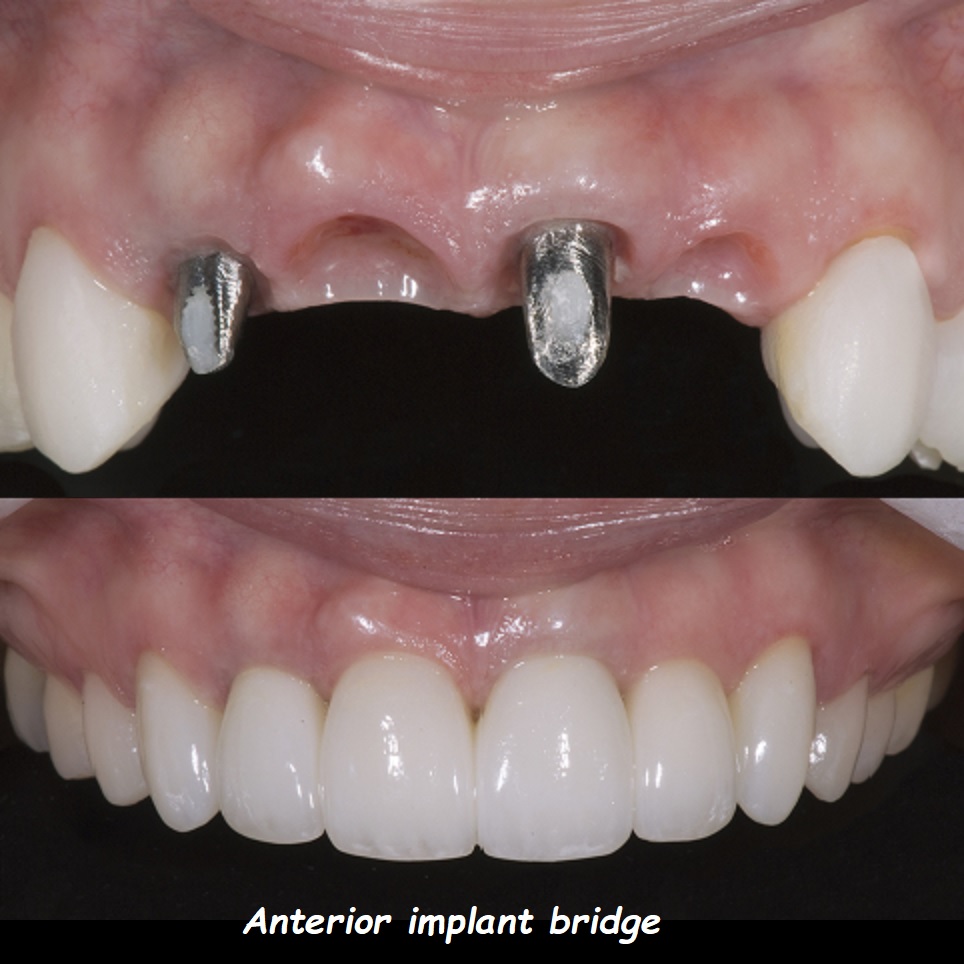 anterior implant bridge