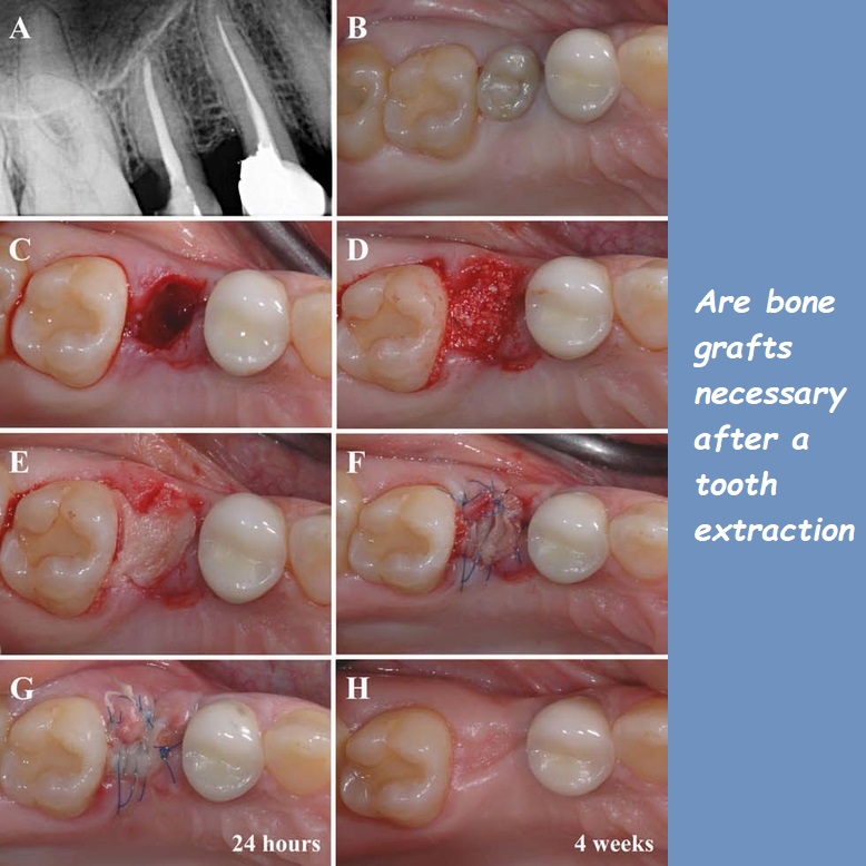 are bone grafts necessary after a tooth extraction