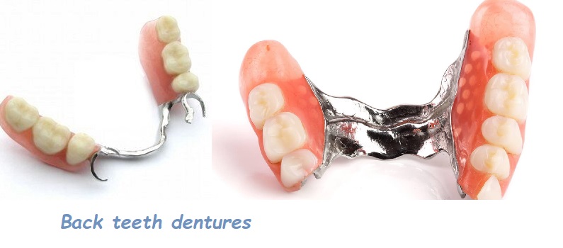 Back teeth dentures