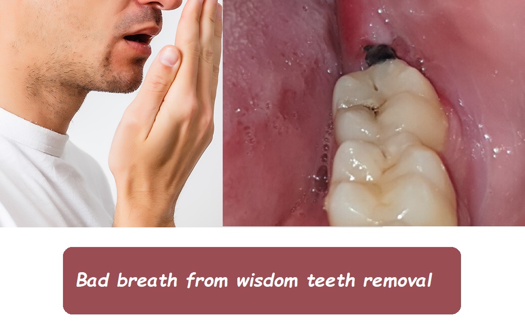 Bad breath from wisdom teeth removal