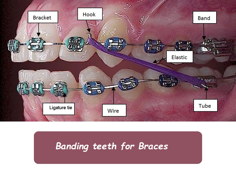 banding teeth