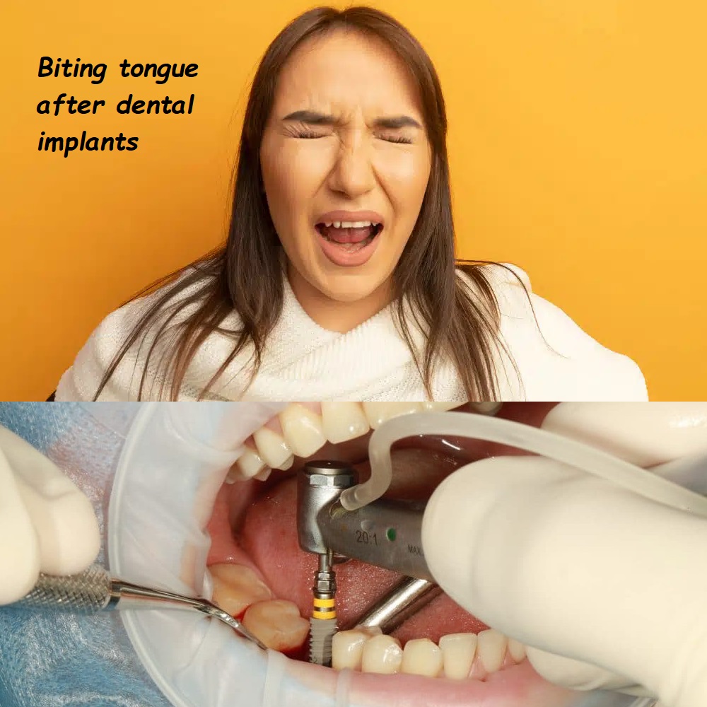 biting tongue after dental implants