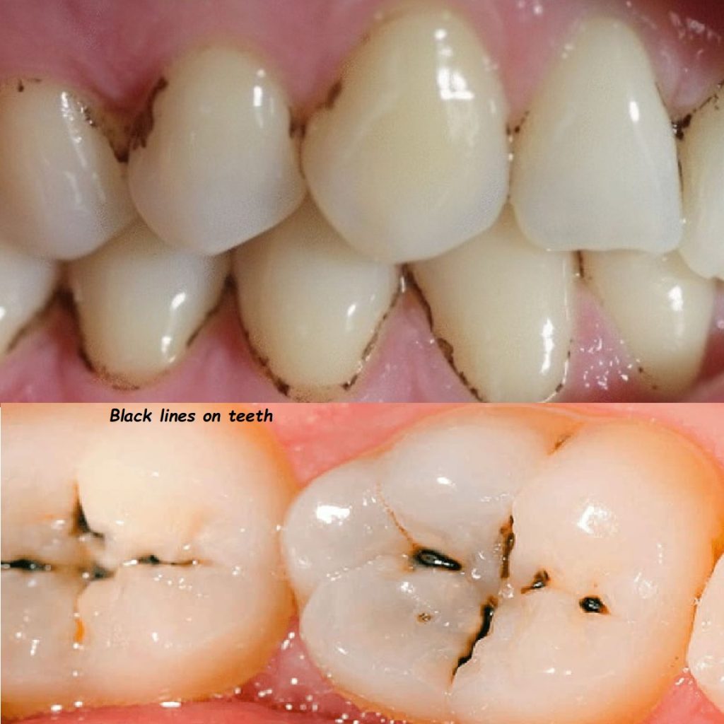 black lines on teeth