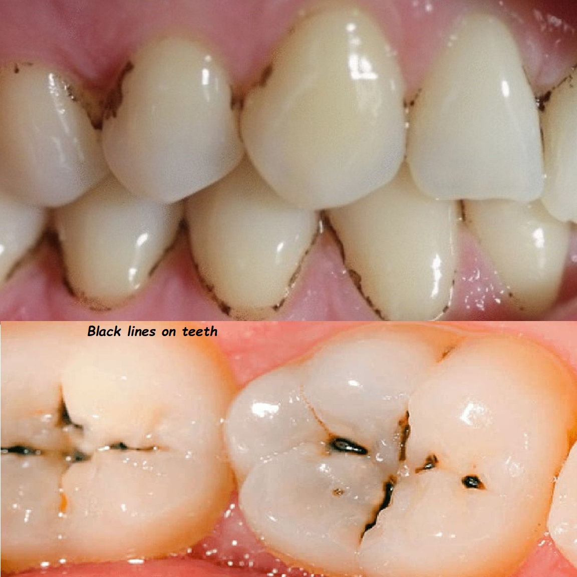 black lines on teeth