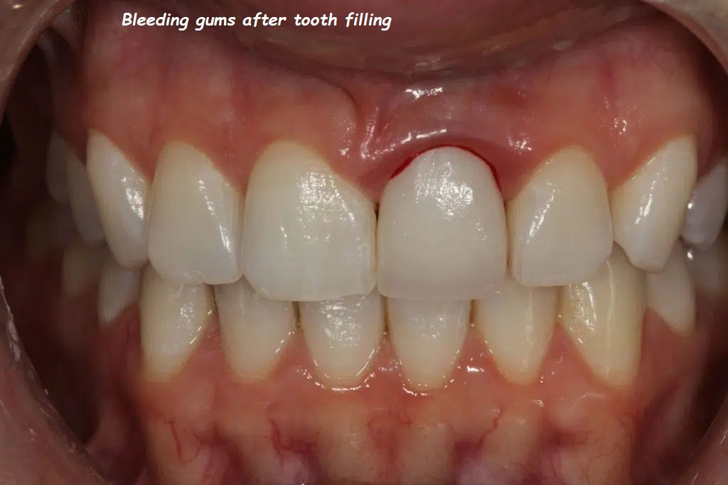 Bleeding gums after tooth filling