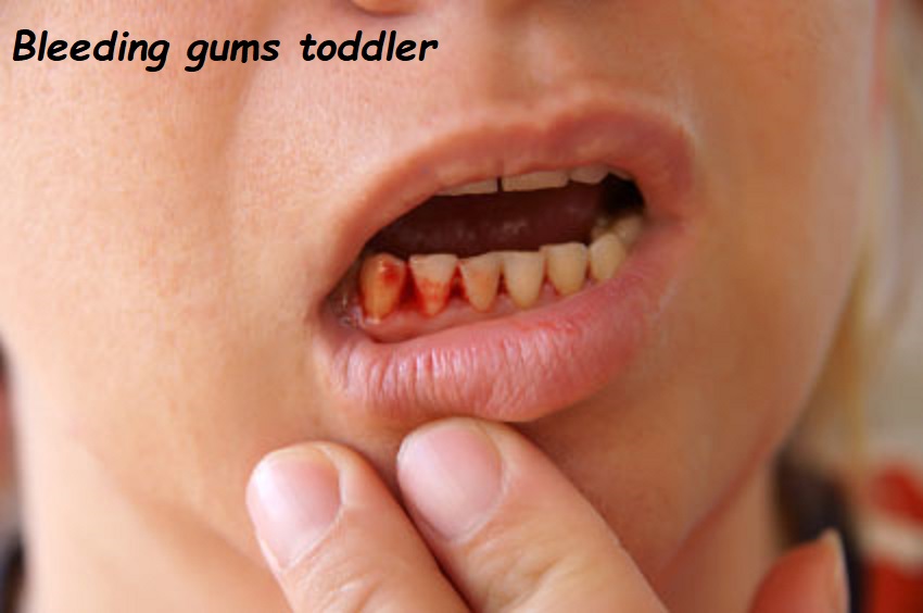 Bleeding gums toddler