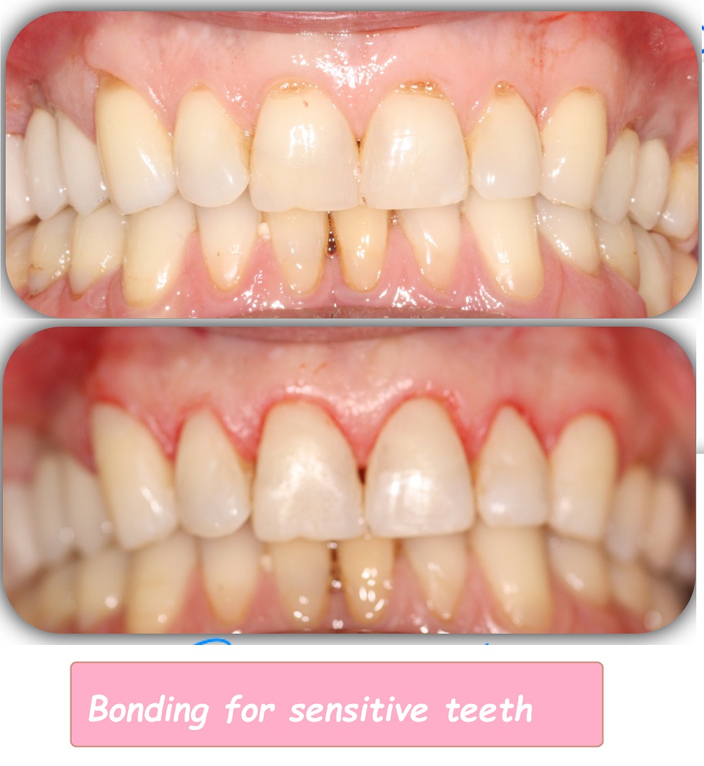 Bonding for sensitive teeth