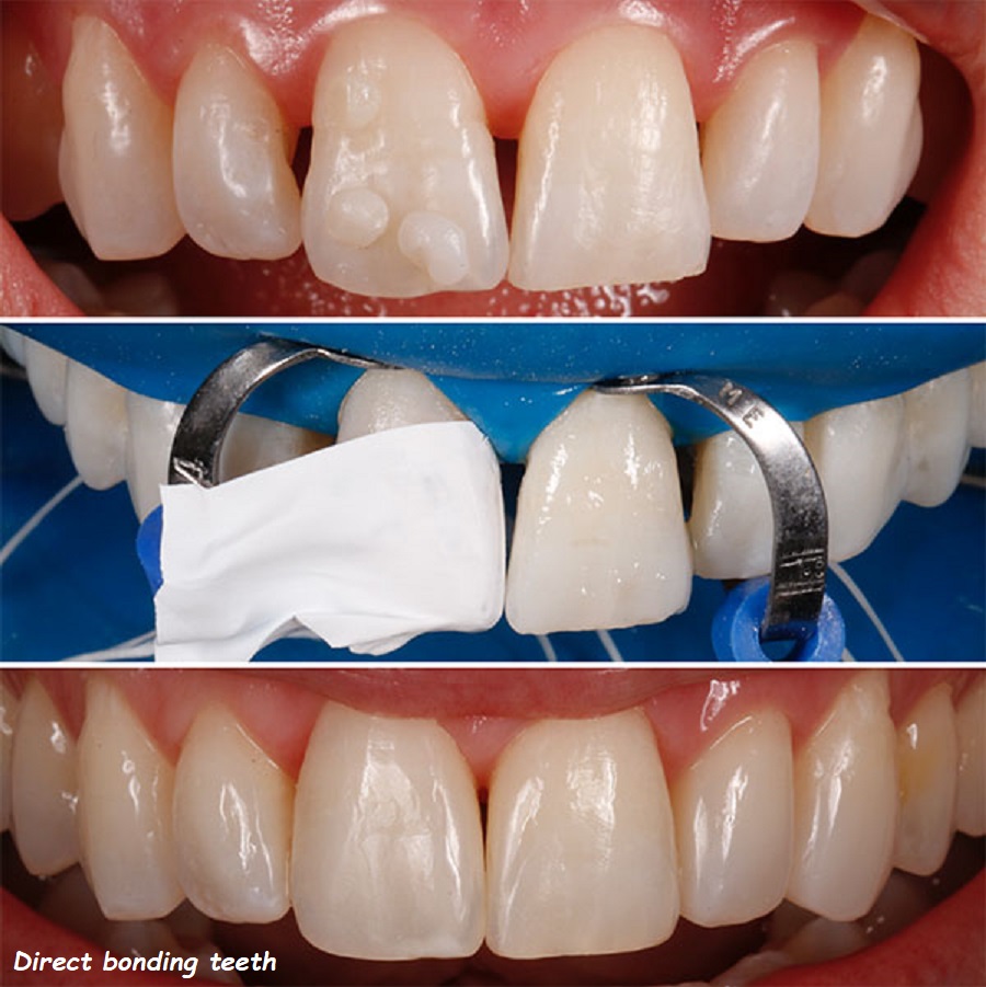 Direct bonding teeth