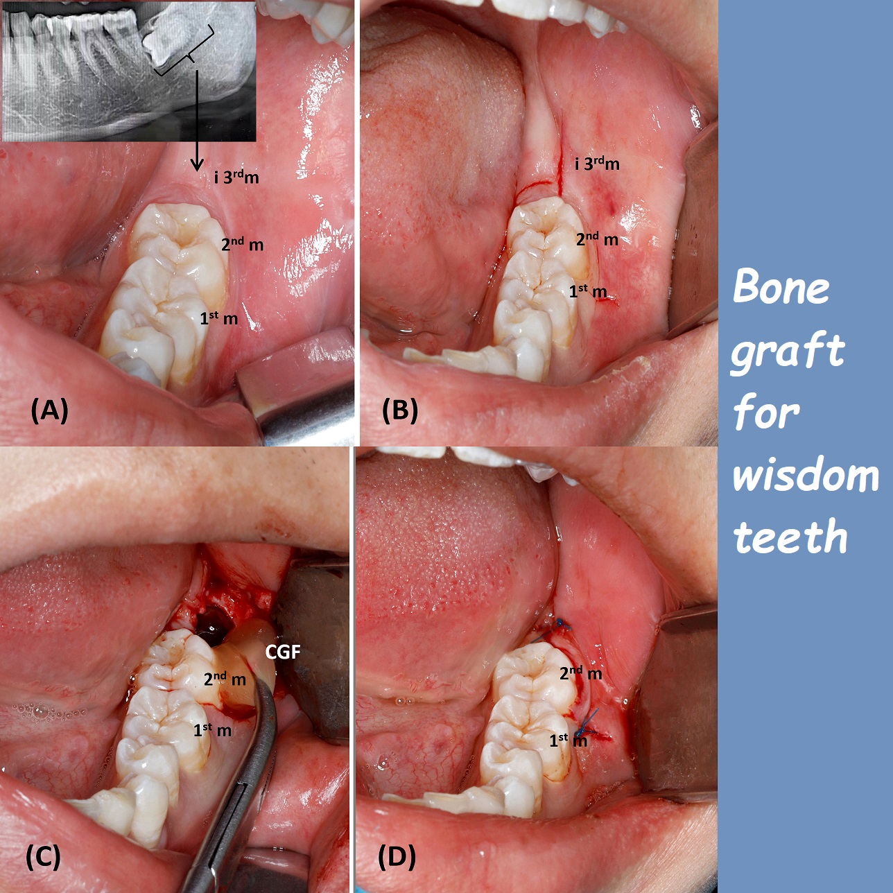 bone graft for wisdom teeth