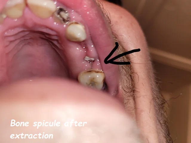 Bone spicule after extraction