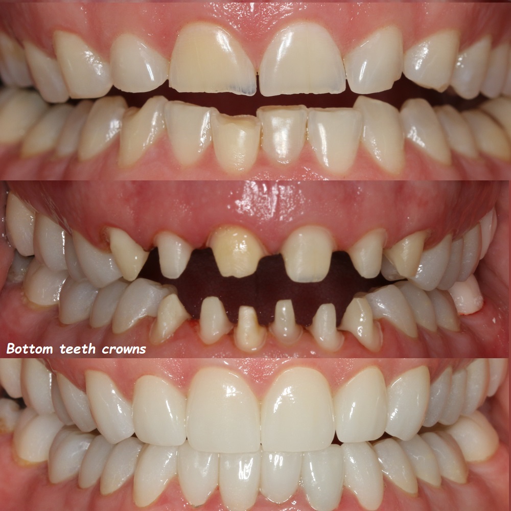 Bottom teeth crowns