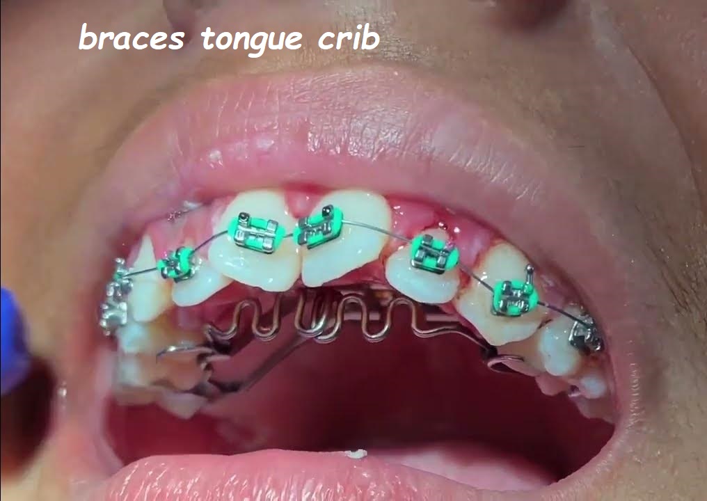 braces tongue crib