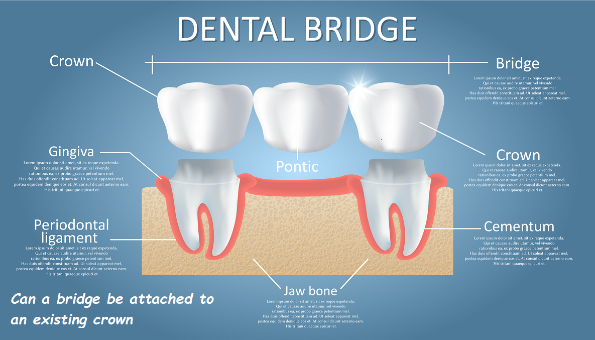 Can a bridge be attached to an existing crown