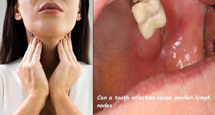 Can a tooth infection cause swollen lymph nodes