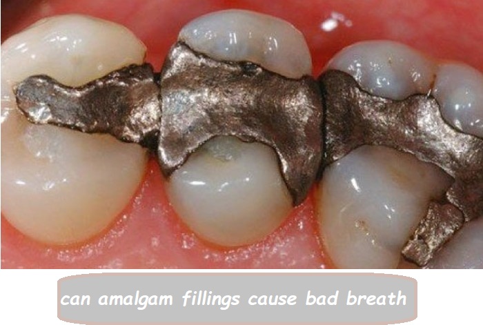 Can amalgam fillings cause bad breath