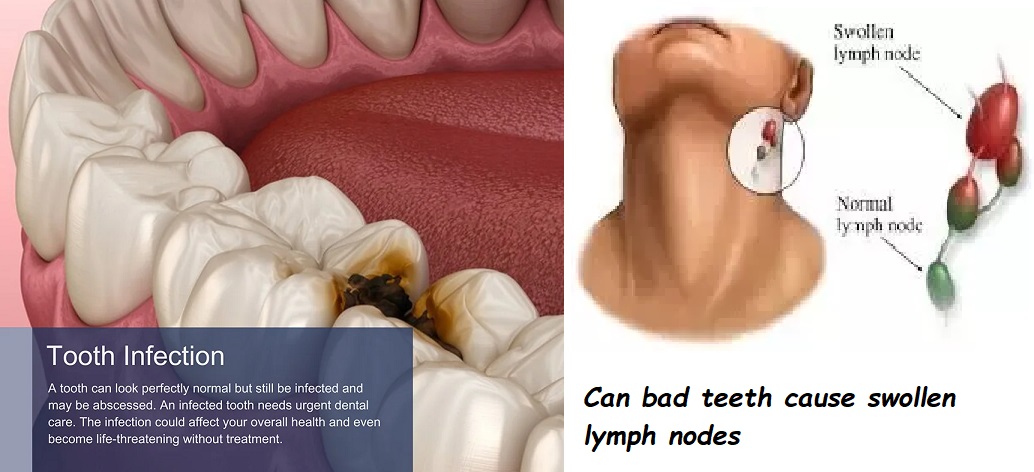 Can bad teeth cause swollen lymph nodes