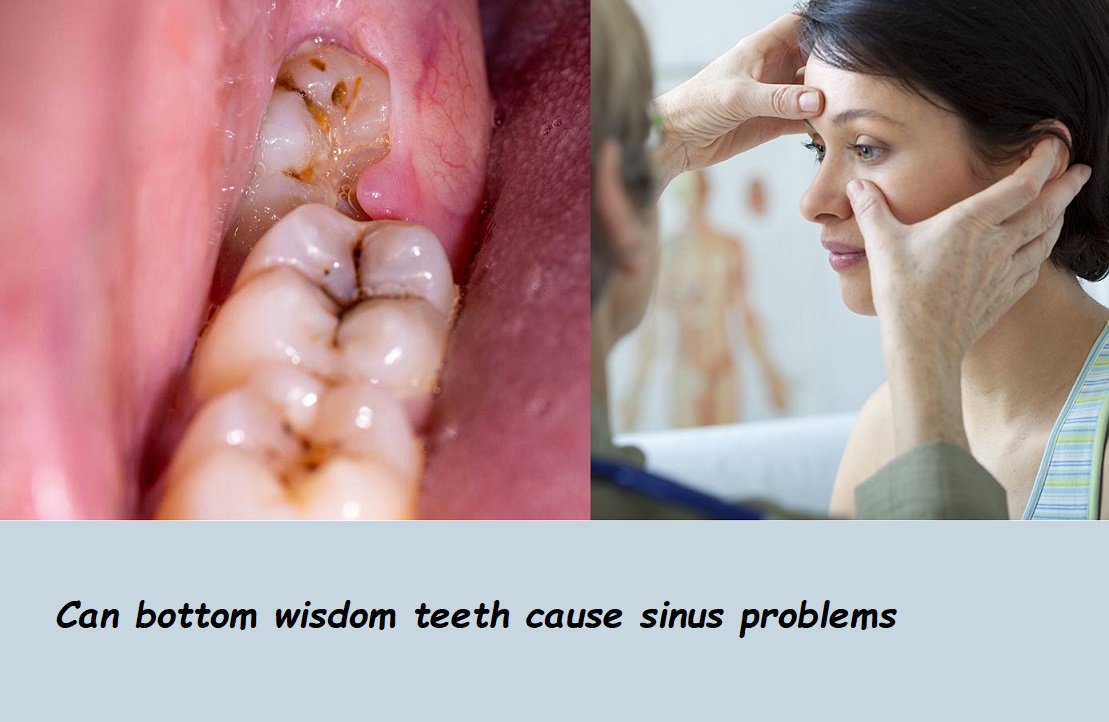 Can bottom wisdom teeth cause sinus problems