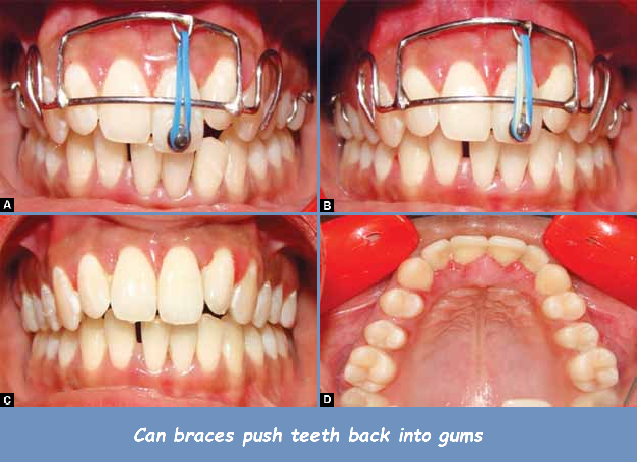 Can braces push teeth back into gums