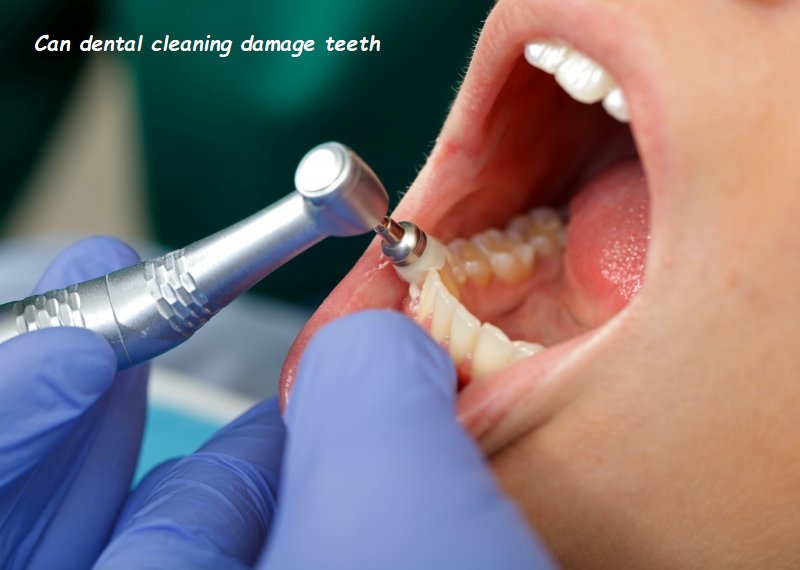 Can dental cleaning damage teeth