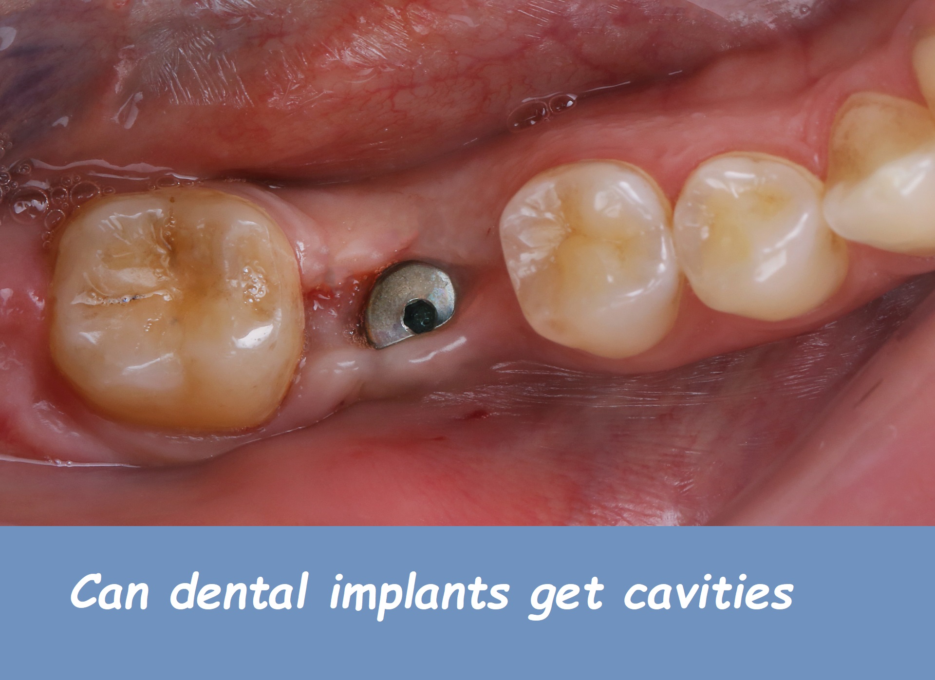 Can dental implants get cavities