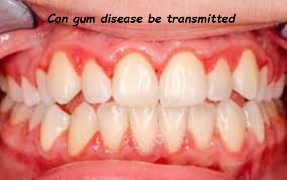 Can gum disease be transmitted