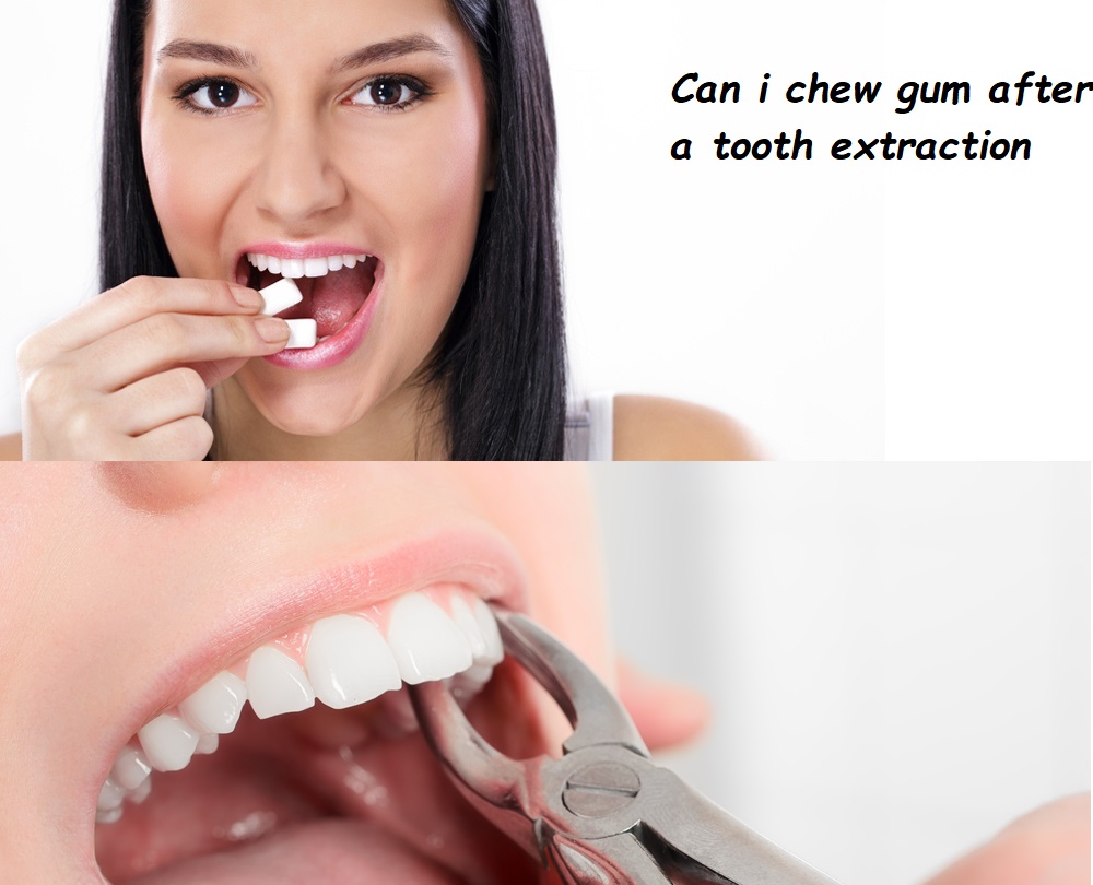 Can i chew gum after a tooth extraction