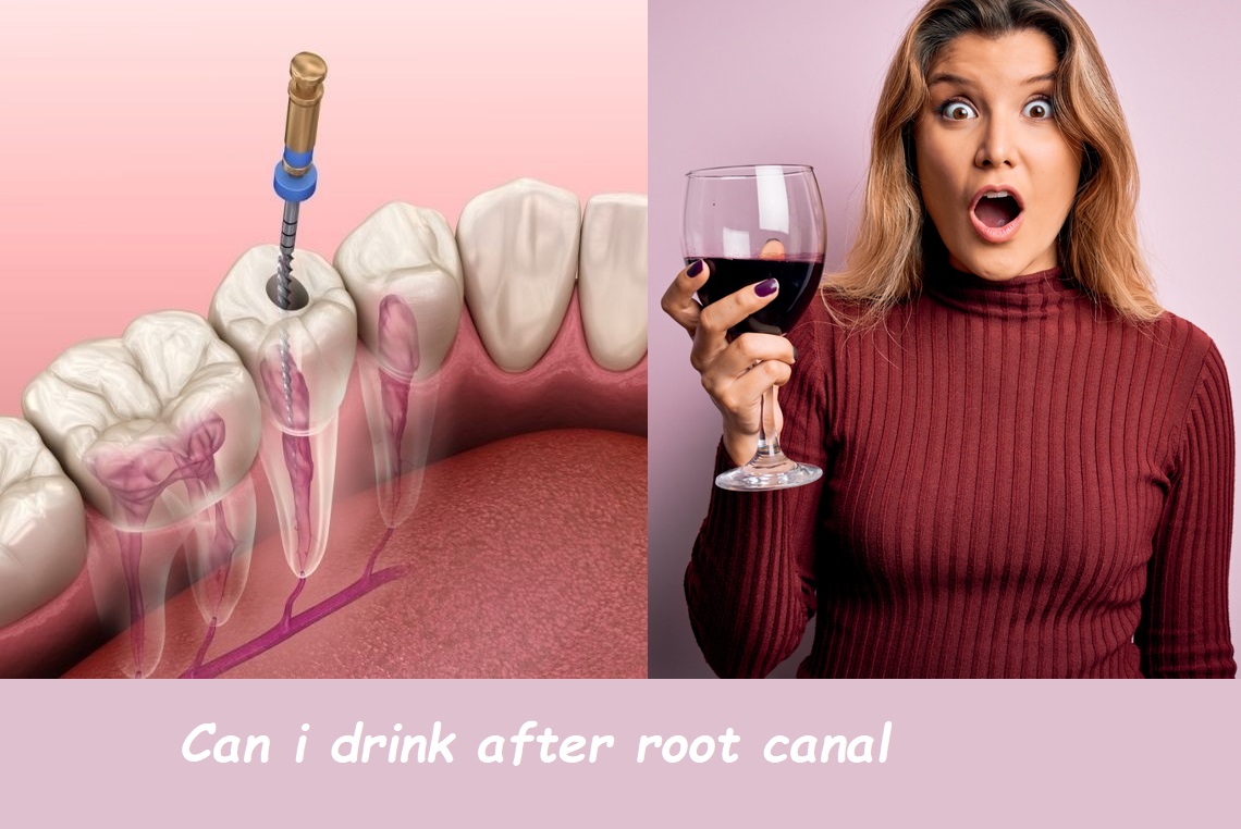 Can i drink after root canal