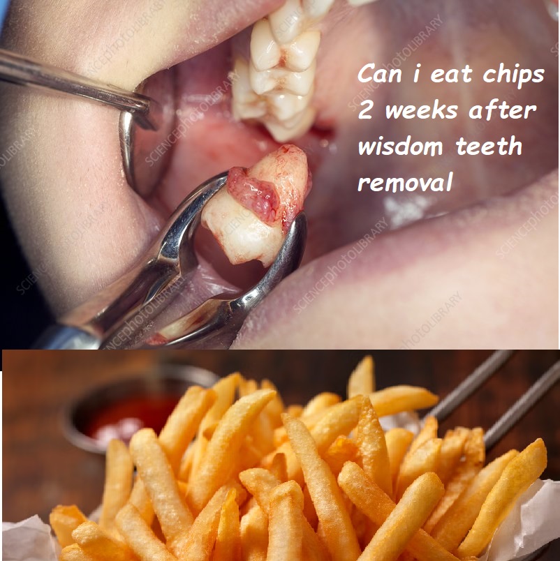 Can i eat chips 2 weeks after wisdom teeth removal