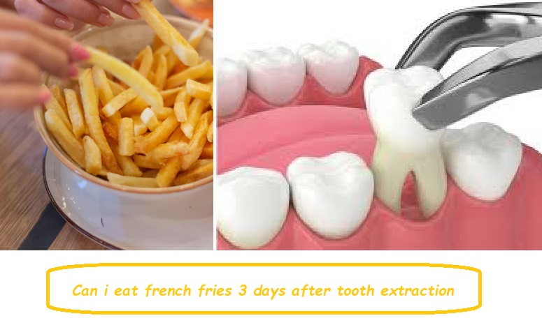 Can i eat french fries 3 days after tooth extraction