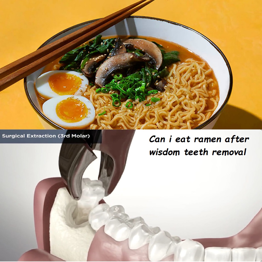 Can i eat ramen after wisdom teeth removal