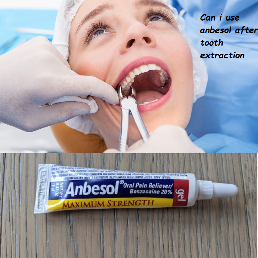 can i use anbesol after tooth extraction