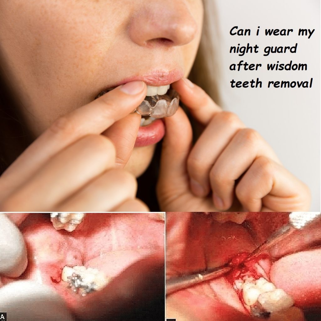 Can i wear my night guard after wisdom teeth removal