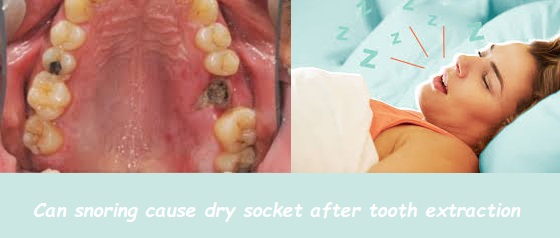 Can snoring cause dry socket after tooth extraction