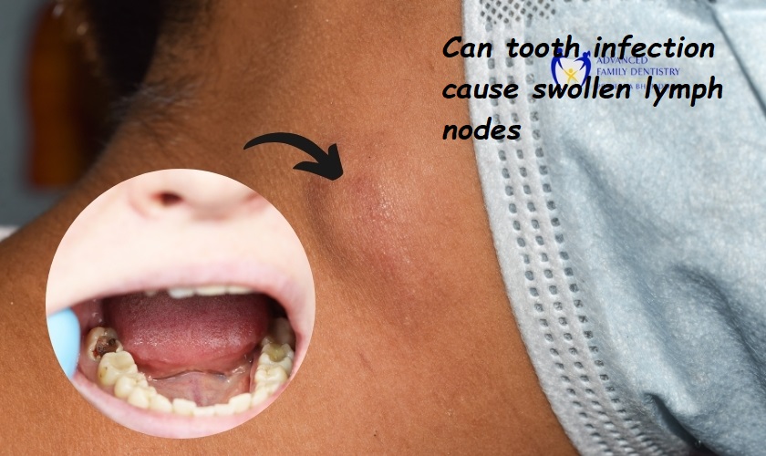 Can tooth infection cause swollen lymph nodes