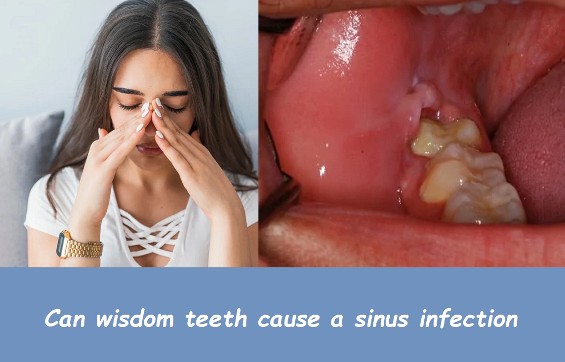 Can wisdom teeth cause a sinus infection