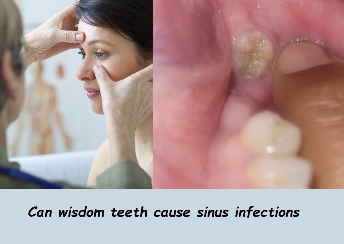 can wisdom teeth cause sinus infections