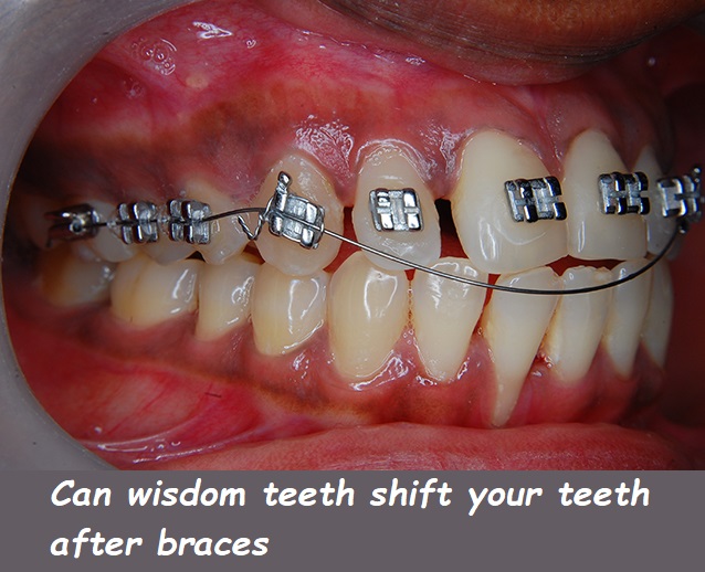 Can wisdom teeth shift your teeth after braces