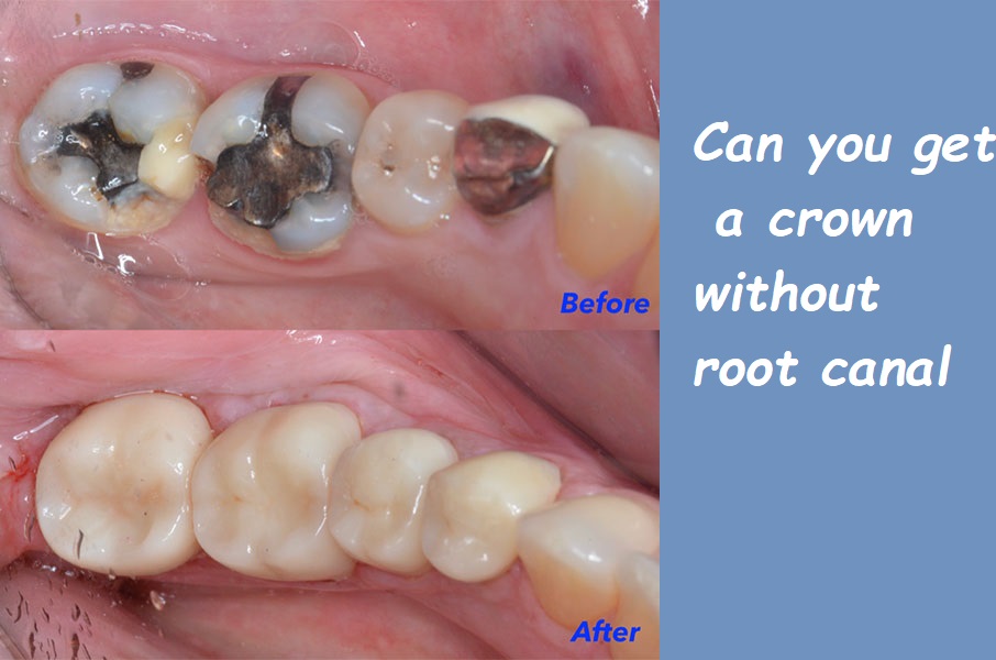 Can you get a crown without root canal