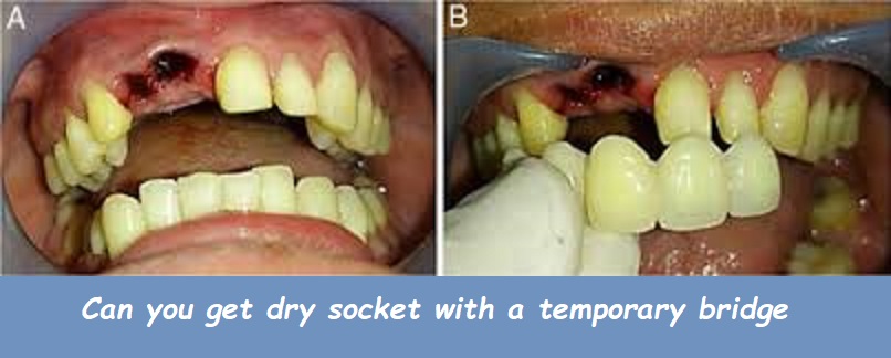 Can you get dry socket with a temporary bridge