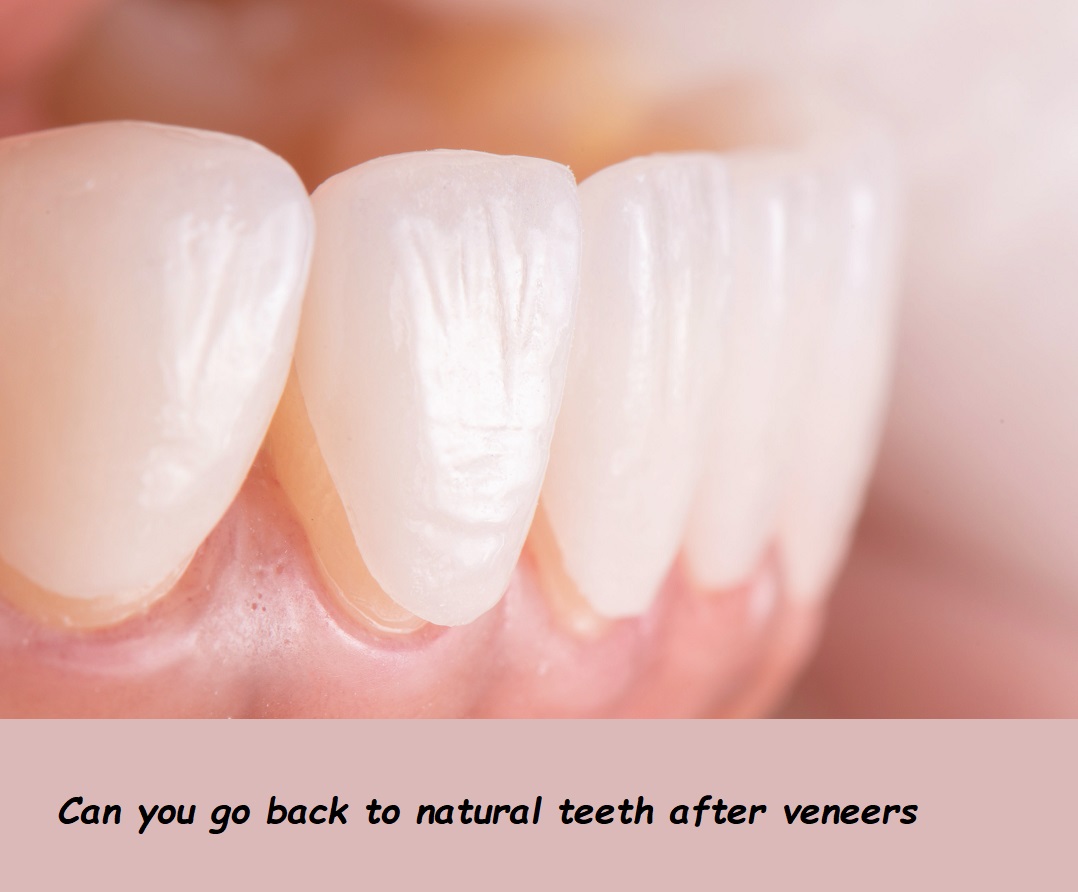 can you go back to natural teeth after veneers