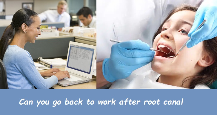 Can you go back to work after root canal