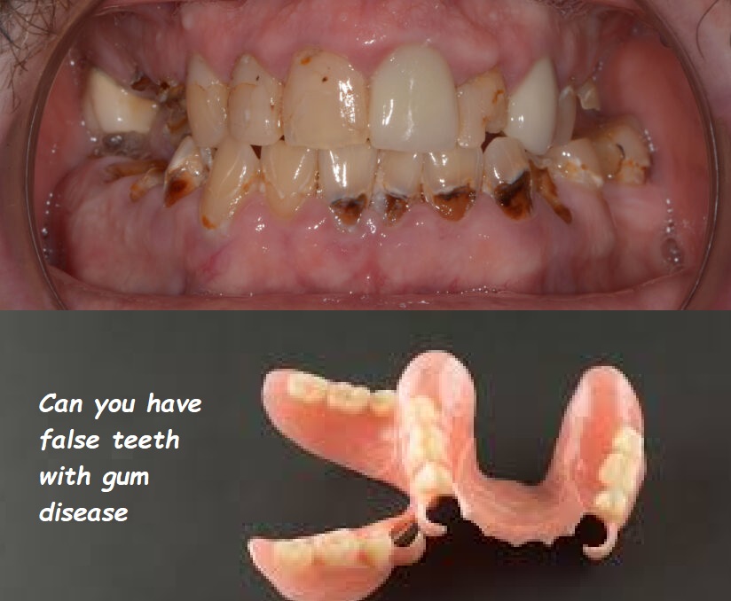 Can you have false teeth with gum disease